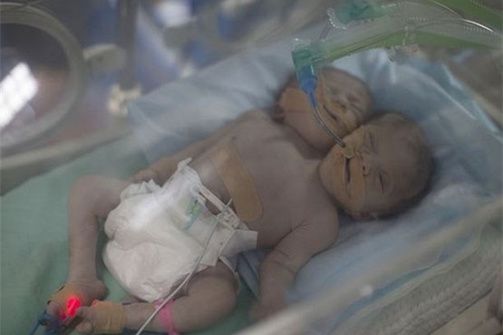 تولد نوزاد دو سر در فلسطین +عکس