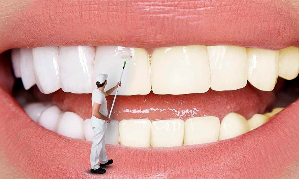 بررسی تفاوت لمینت و کامپوزیت و بلیچینگ
